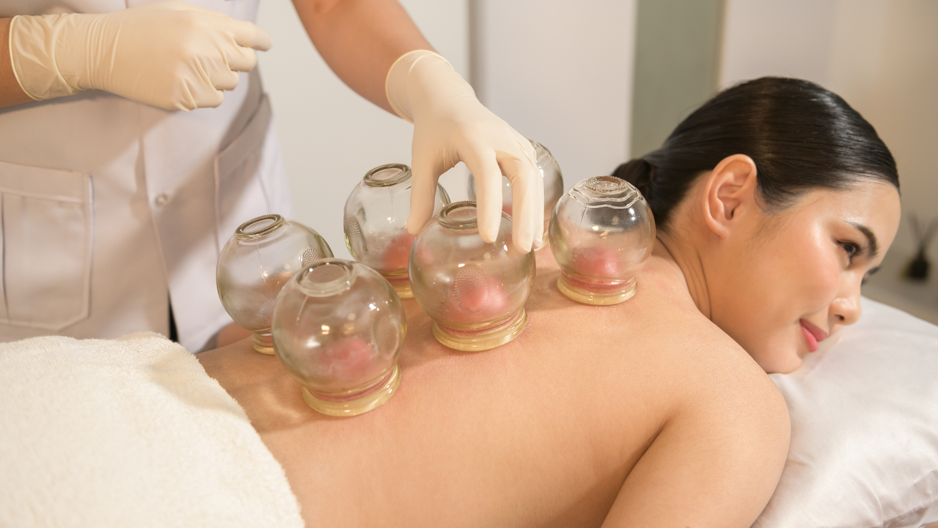The Ultimate Cupping Therapy Guide